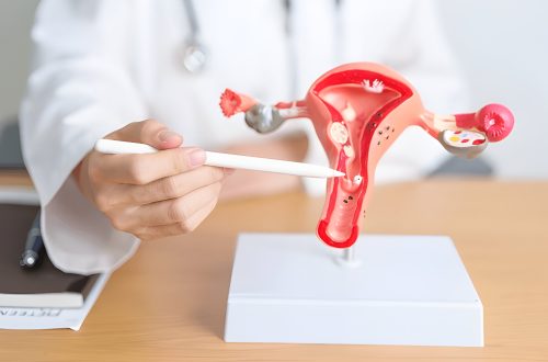 FIBROIDS